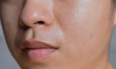 Ciri kulit dehidrasi vs berminyak