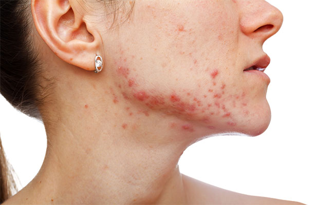 Cara atasi jerawat hormon