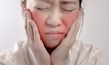 Cara atasi heat sensation wajah